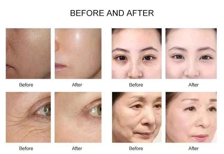 Meso Mesotherapy Gun Injector EMS Microneedle RF Machine No Needle Face Lifting Water Injection Anti Aging Salon Beauty Device